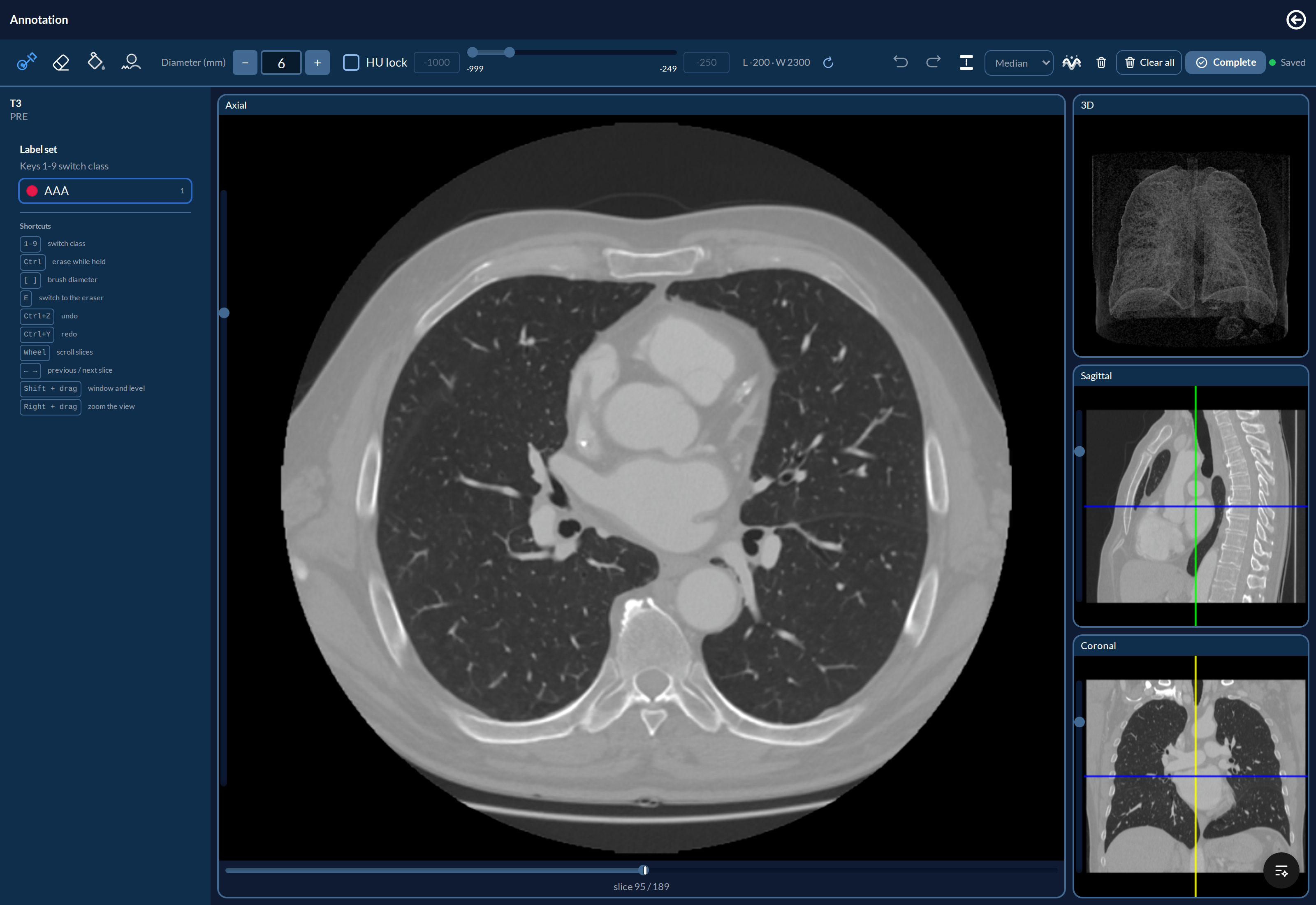 The editor on a mask project: toolbar on top, label panel on the left, the axial view in
the middle, and the 3D, sagittal and coronal previews on the
right