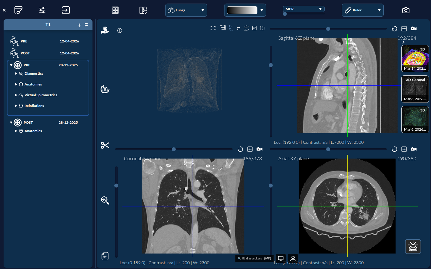 Measurement tools on a CT slice