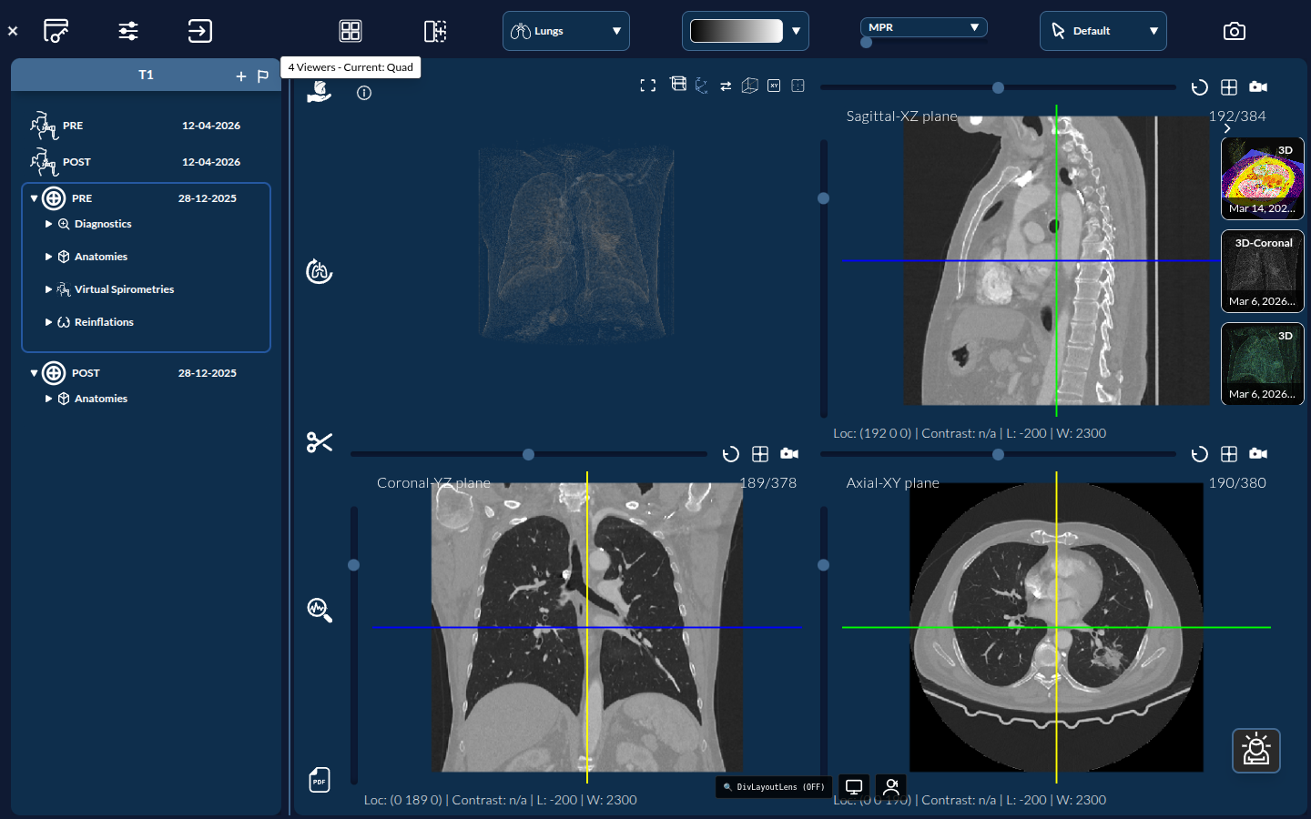 4-Viewer (Quad) layout: 3D plus Axial, Coronal and Sagittal slices