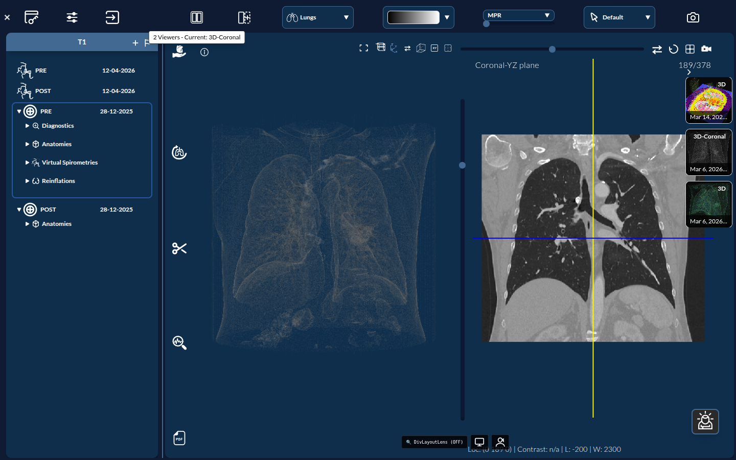 2-Viewer layout: 3D plus a Coronal slice