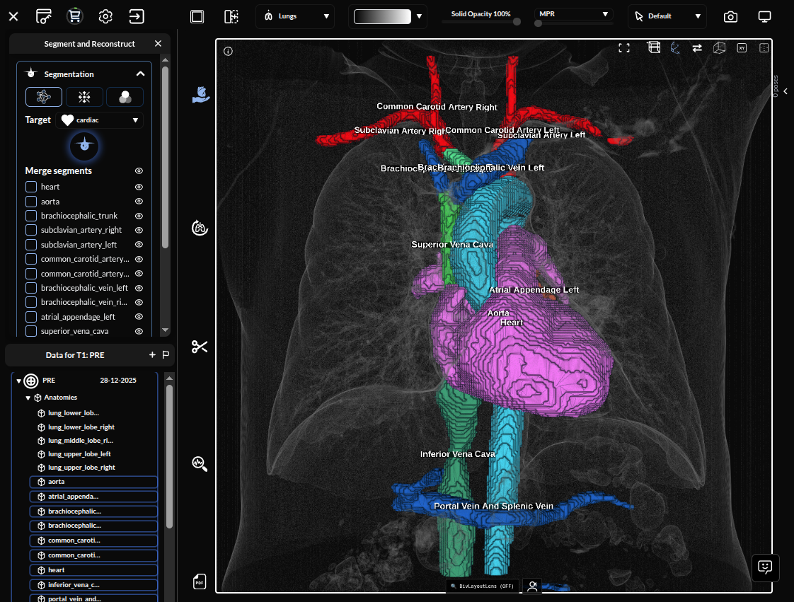 3D reconstruction — segmented lobes in the viewport