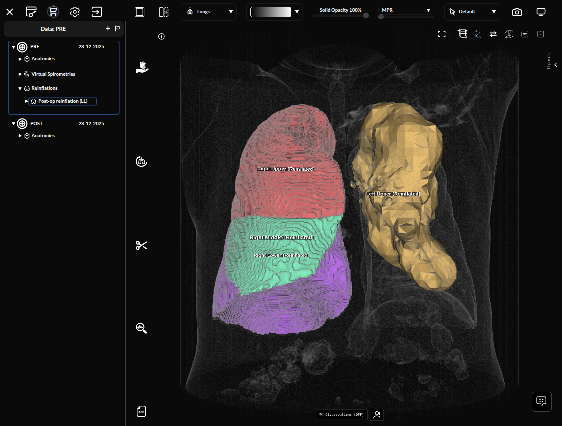Reinflation result — lobes labelled Right Upper, Right Middle, Right Lower (Reinflated) and Left Upper (Reinflated)
