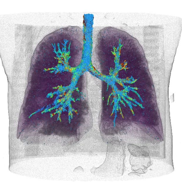 Both lungs reconstructed from a chest CT during a simulated forced expiration: tracers stream out through the airway tree, coloured by airflow speed